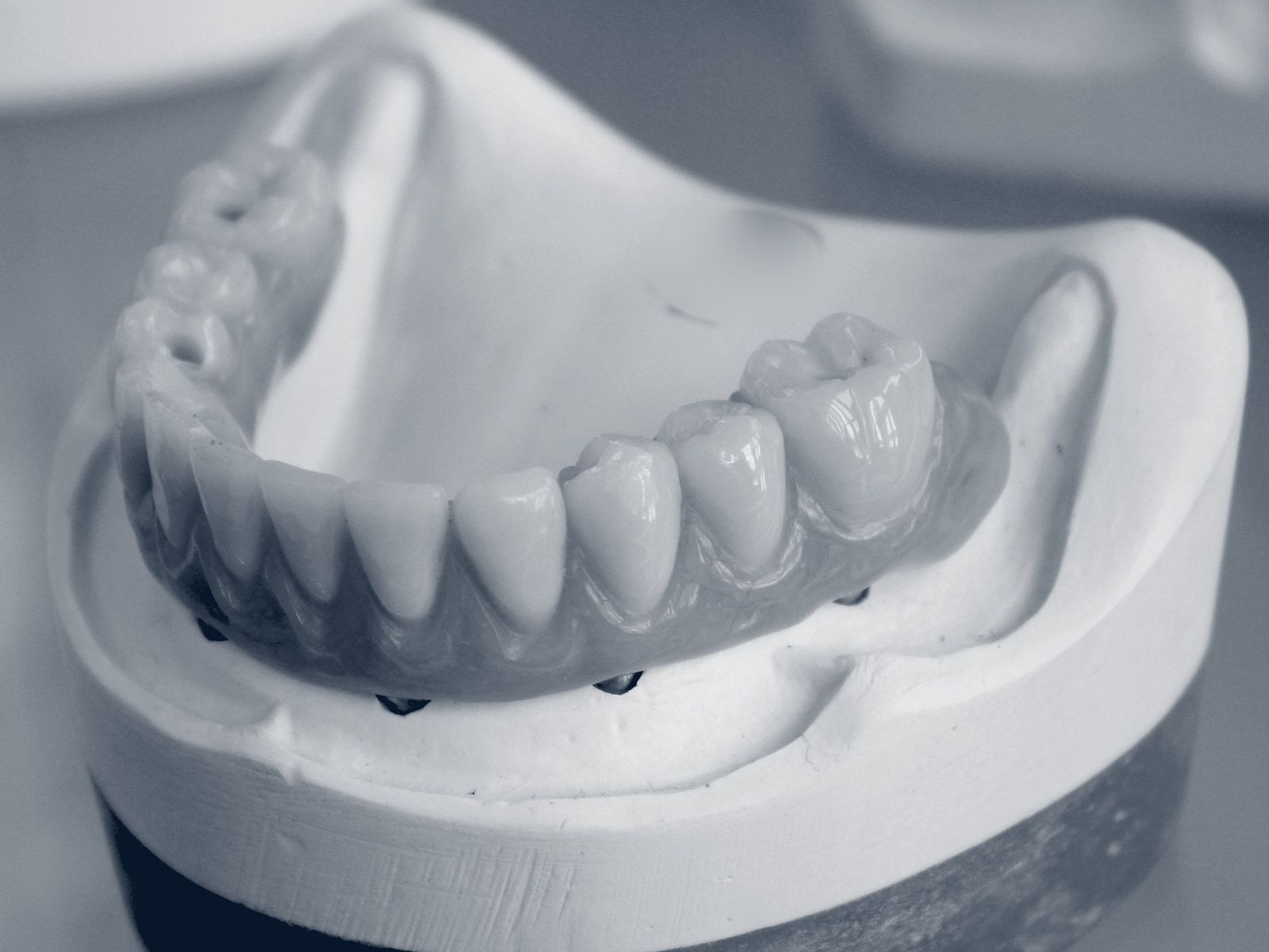 A lower denture resting on a plaster cast.